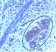 Mammary tissue with cancer cells positive for P-Rex1 (inside oval, stained brown). P-Rex1 is expressed only in cancer cells, not in normal tissue. 